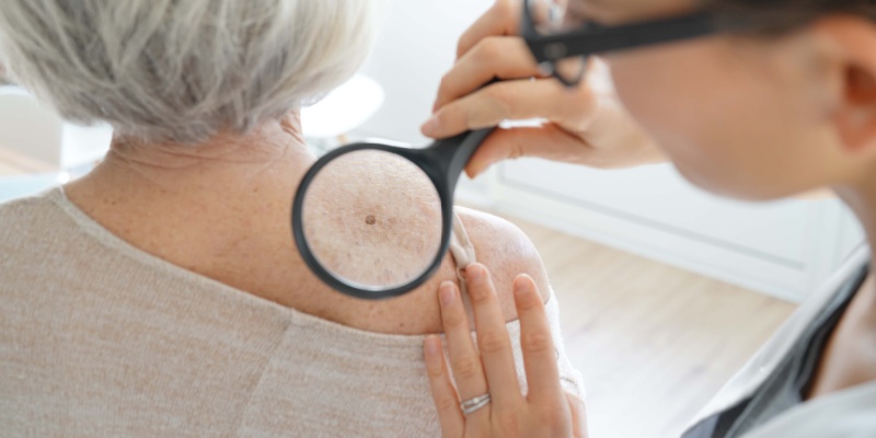 cancer de la peau chez les seniors