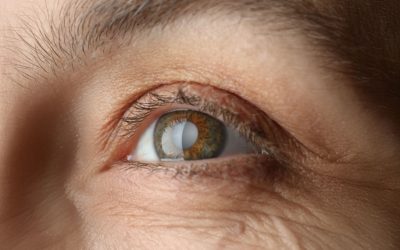 La cataracte : qu’est-ce-que c’est ?